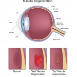 Nutrition is important in protection against Macular Degeneration