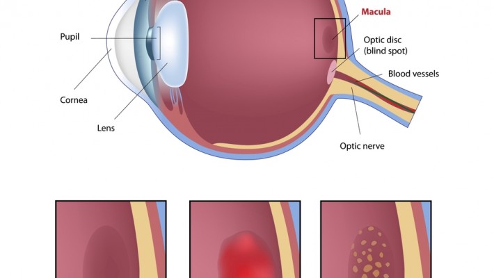 Nutrition is important in protection against Macular Degeneration